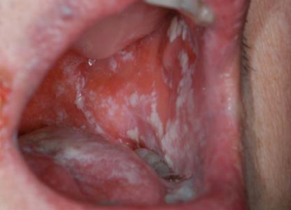 From saliva infection yeast Oral Thrush